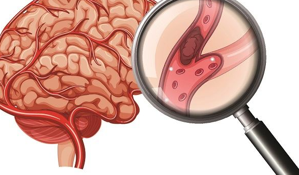 Jenis dan Metode Pengobatan Stroke, Dari Terapi Hingga Prosedur Medis